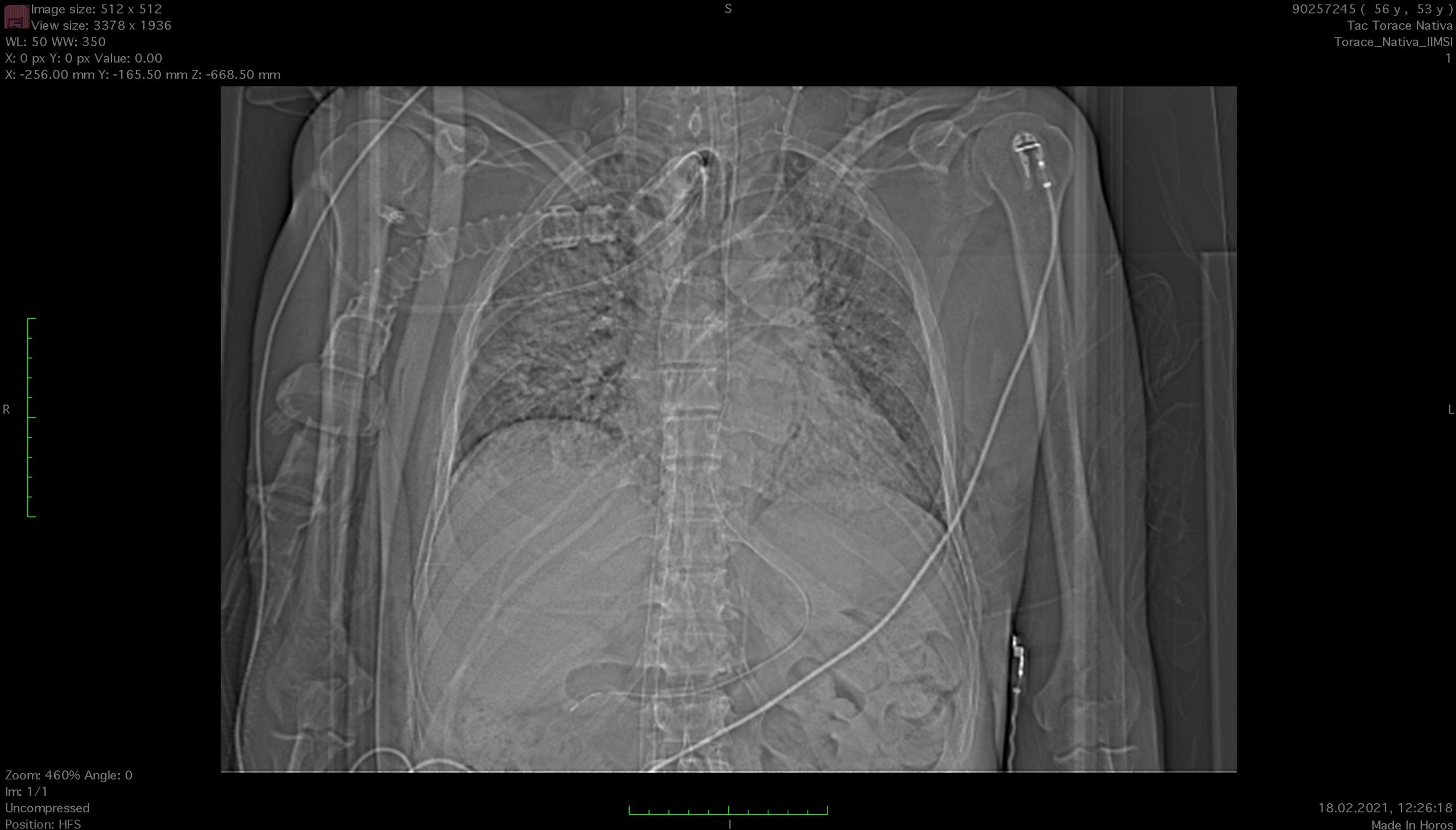TAC20210218 - ECMO - Diario di una vita stravolta