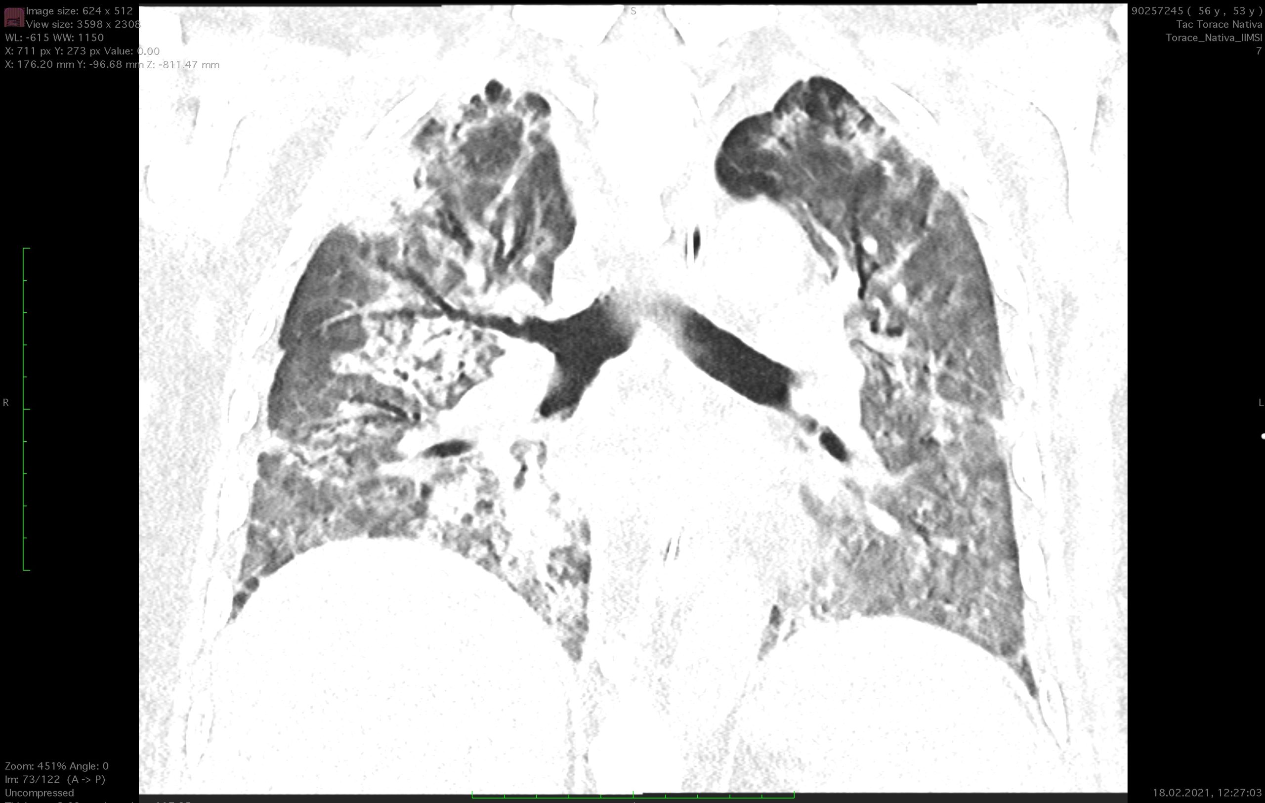TAC20210218_3 - ECMO - Diario di una vita stravolta