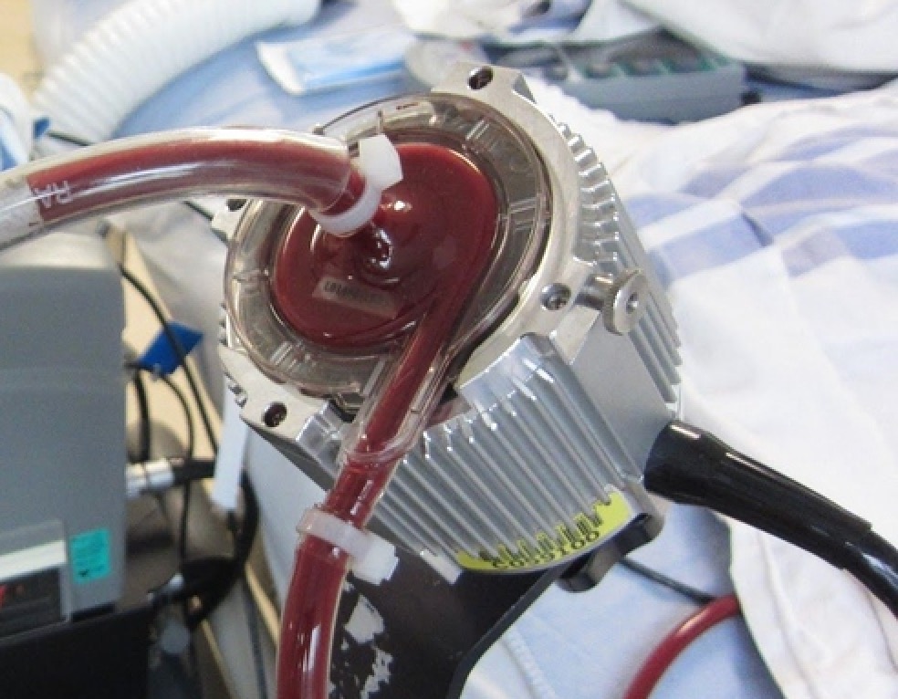 Pump-1 - ECMO - Diario di una vita stravolta